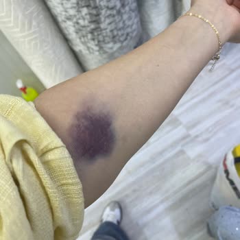 Dikkatsiz Hemşire Nedeniyle Sağlığım Tehlikeye Girdi