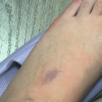 Yurt Yönetiminin İhmali Sonucu Yaralanma Ve Yetersiz Destek