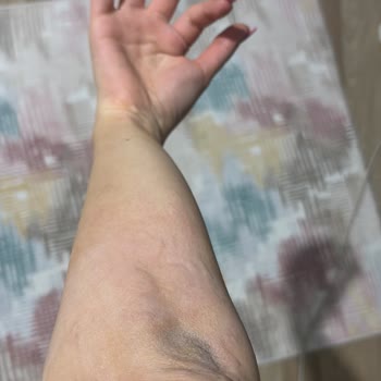 Lazer Epilasyon Sonrası Cilt Sorunları Ve Yetersiz Destek