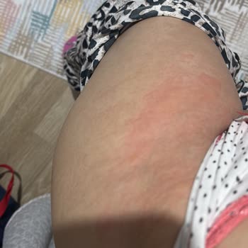 Lazer Epilasyon Sonrası Cilt Sorunları Ve Yetersiz Destek