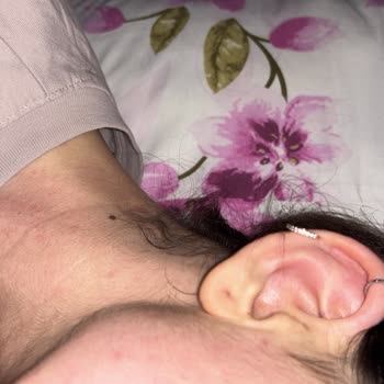 Lazer Epilasyon Sonrası Cilt Sorunları Ve Yetersiz Destek