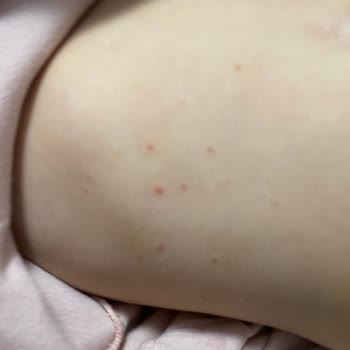 Mustela Stelatopia Krem Ciltte Alerjik Reaksiyona Sebep Oldu