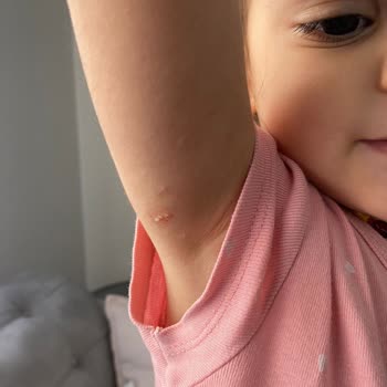 Mustela Stelatopia Krem Ciltte Alerjik Reaksiyona Sebep Oldu