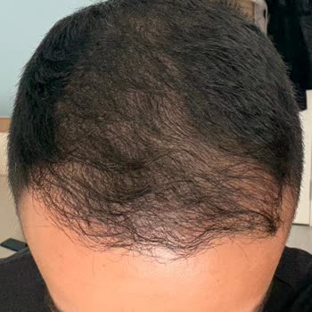 EsteVia Clinic Saç Ekimi İşleminden Hiçbir Olumlu Sonuç Alamadım!