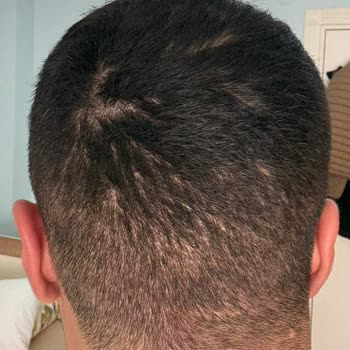 EsteVia Clinic Saç Ekimi İşleminden Hiçbir Olumlu Sonuç Alamadım!