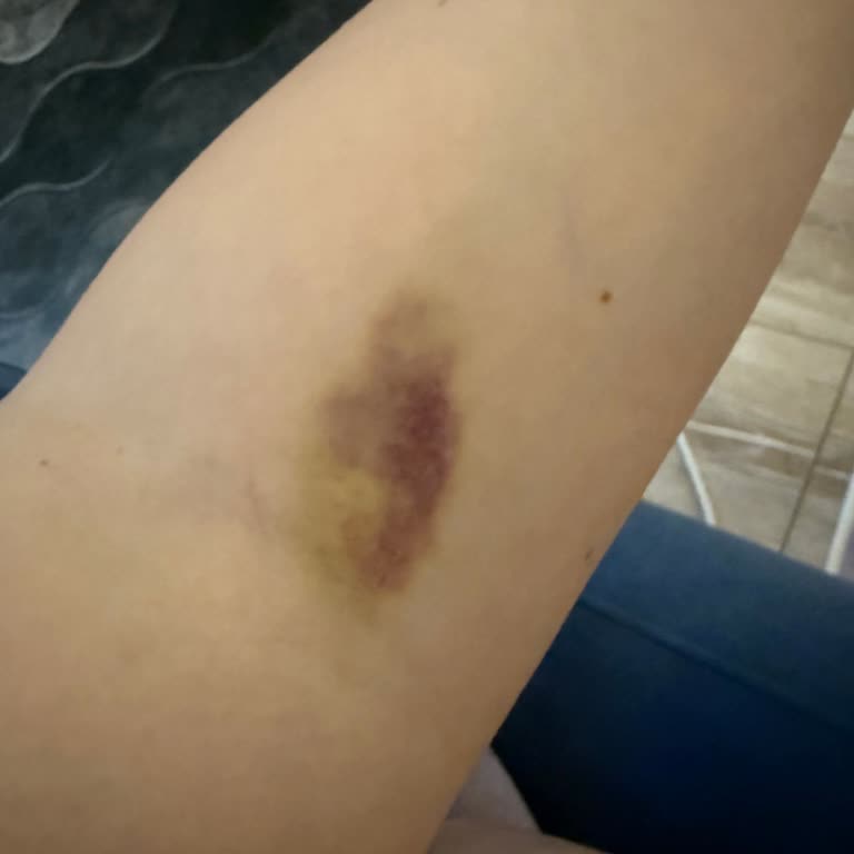 Kan Alımı Sonrası Kolumda Uzun Süreli Morarma