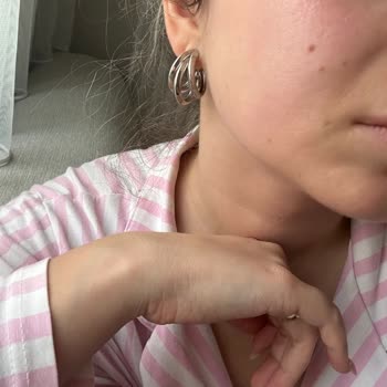 Pirinçli Maske Kullanımı Sonrası Yüzde Şiddetli Yanma Ve Kızarıklık