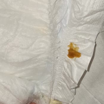 Molfix 5 Numara Bebek Bezinde Tekrarlayan Kalite Sorunları Ve Sağlık Riski