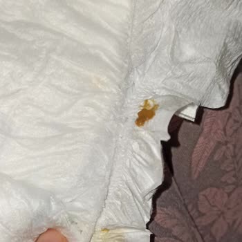 Molfix 5 Numara Bebek Bezinde Tekrarlayan Kalite Sorunları Ve Sağlık Riski