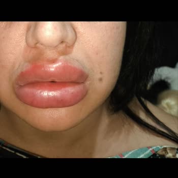 Este Clinic Bakırköy Dudak Dolgusu Sonrası Şiddetli Şişlik ve Yetersiz Klinik Desteği