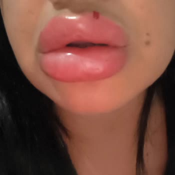 Este Clinic Bakırköy Dudak Dolgusu Sonrası Şiddetli Şişlik ve Yetersiz Klinik Desteği