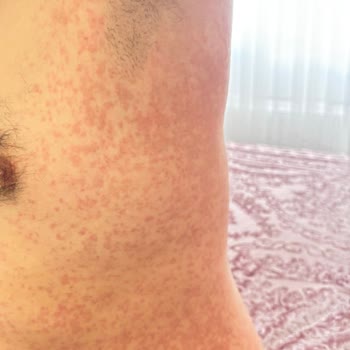 OMO Deterjan Sonrası Ciddi Alerjik Reaksiyon Ve Kabarmalar Yaşadık