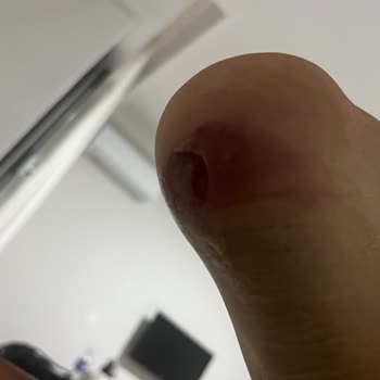 Satın Aldığım Bot Ayağımı Yaraladı, İade Talebim Reddedildi