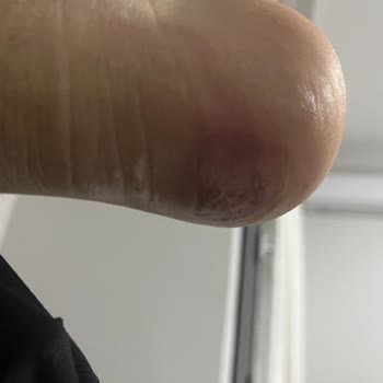 Satın Aldığım Bot Ayağımı Yaraladı, İade Talebim Reddedildi