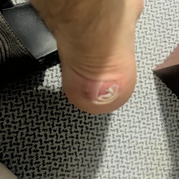 Satın Aldığım Bot Ayağımı Yaraladı, İade Talebim Reddedildi