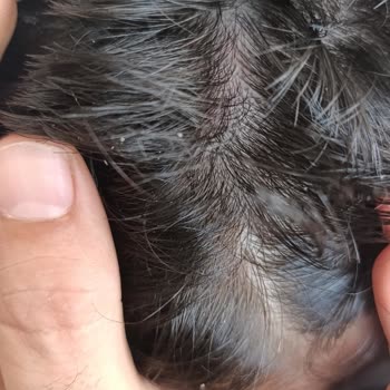 Aldığım Şampuan Saç Dökülmesi Ve Kepeklenmeye Yol Açtı, İade Talebime Dönüş Yapılmadı