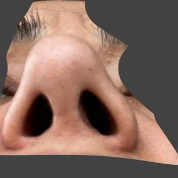Burun Estetiği Sonrası Şekil Bozukluğu Ve Doktorun İlgisiz Yaklaşımı Nedeniyle Yaşanan Mağduriyet