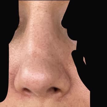 Burun Estetiği Sonrası Şekil Bozukluğu Ve Doktorun İlgisiz Yaklaşımı Nedeniyle Yaşanan Mağduriyet