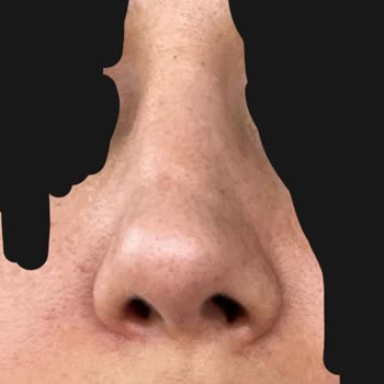 Burun Estetiği Sonrası Şekil Bozukluğu Ve Doktorun İlgisiz Yaklaşımı Nedeniyle Yaşanan Mağduriyet