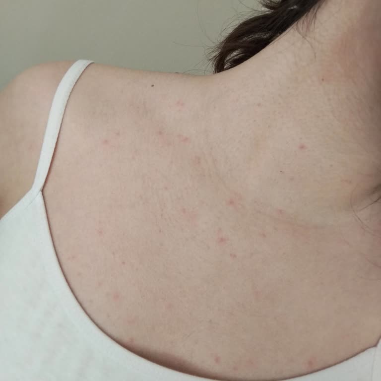 Vücut Yağı Kullanımı Sonrası Ciltte Kaşıntı Ve Egzama Benzeri Reaksiyonlar Oluştu