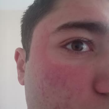 Yüz Temizleme Jeli Cildimde Yoğun Kızarıklık Ve Yanma Yaptı, İlgi Bekliyorum