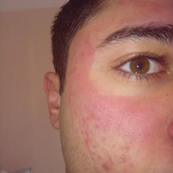 Yüz Temizleme Jeli Cildimde Yoğun Kızarıklık Ve Yanma Yaptı, İlgi Bekliyorum