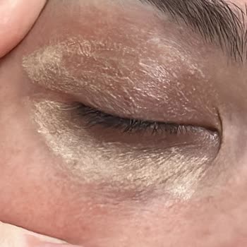 Kalıcı İzler Ve Psikolojik Zarar: Vitiligo İşlemi Sonrası Mağduriyetim