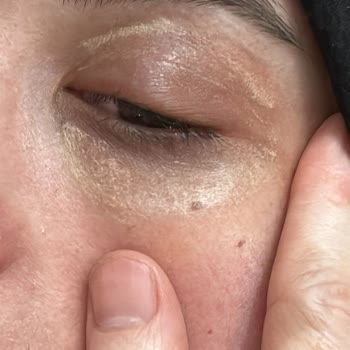 Kalıcı İzler Ve Psikolojik Zarar: Vitiligo İşlemi Sonrası Mağduriyetim