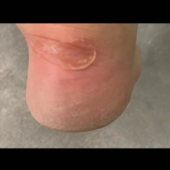 Sorunlu Ayakkabı Ve Yetersiz İnceleme Sonucu Nedeniyle Mağduriyet