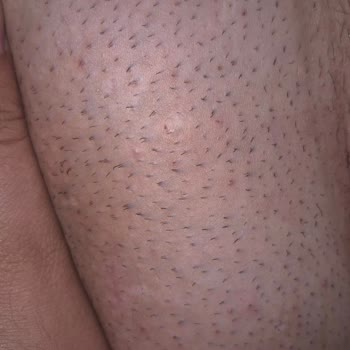 Epify Hair Removal Sensitive Krem Cildimde Tahrişe Ve Etkisizliğe Sebep Oldu