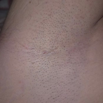 Epify Hair Removal Sensitive Krem Cildimde Tahrişe Ve Etkisizliğe Sebep Oldu