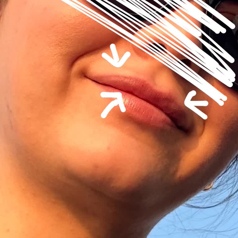 Bakırköy İlya Clinic Dudak Dolgusu Hüsranı!