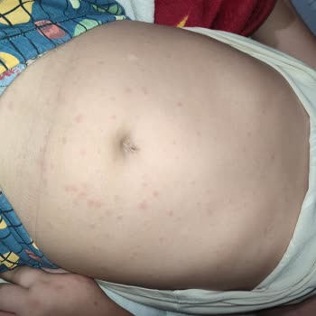 Klamoks Es 600 Antibiyotik Oğlumda Ciddi Alerjik Reaksiyona Yol Açtı