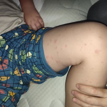 Klamoks Es 600 Antibiyotik Oğlumda Ciddi Alerjik Reaksiyona Yol Açtı