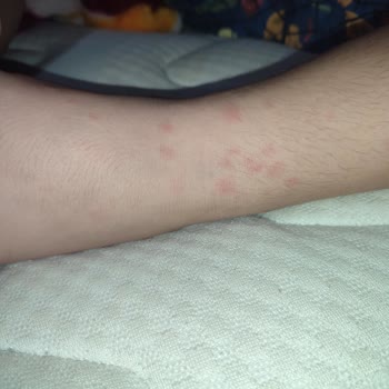 Klamoks Es 600 Antibiyotik Oğlumda Ciddi Alerjik Reaksiyona Yol Açtı