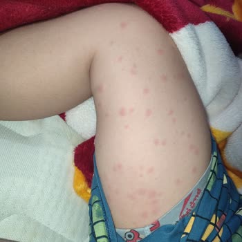 Klamoks Es 600 Antibiyotik Oğlumda Ciddi Alerjik Reaksiyona Yol Açtı