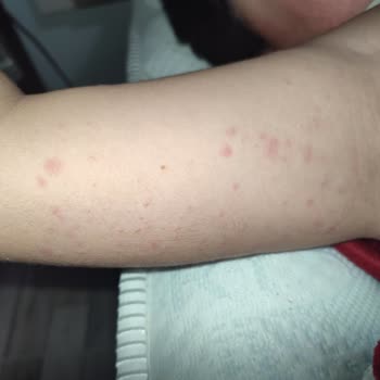 Klamoks Es 600 Antibiyotik Oğlumda Ciddi Alerjik Reaksiyona Yol Açtı