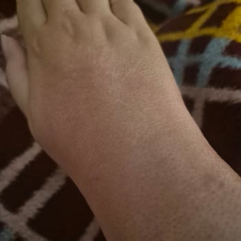 Krem Sonrası Ciltte Kalıcı Sorunlar Ve Çözüm Beklentisi