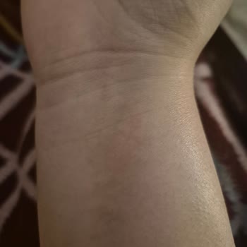 Krem Sonrası Ciltte Kalıcı Sorunlar Ve Çözüm Beklentisi