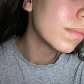 Krem Alerji Yaptı, İade Ve Açıklama Talebim Karşılanmadı