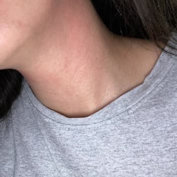 Krem Alerji Yaptı, İade Ve Açıklama Talebim Karşılanmadı