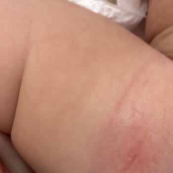 Molfix Bebek Bezinde Sert Parça Nedeniyle Oluşan Tahriş Endişesi