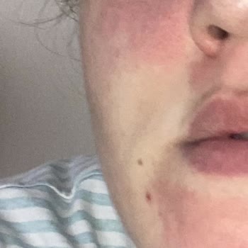 Numune Serum Cildimde Şiddetli Yanma Ve Kızarıklığa Sebep Oldu