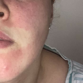 Numune Serum Cildimde Şiddetli Yanma Ve Kızarıklığa Sebep Oldu