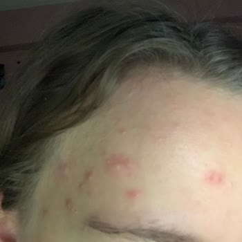 Garnier Vitamin C Krem Cildimde Yanma Ve Sivilceye Sebep Oldu, İade İstiyorum