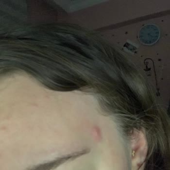 Garnier Vitamin C Krem Cildimde Yanma Ve Sivilceye Sebep Oldu, İade İstiyorum