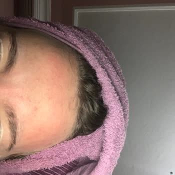 Garnier Vitamin C Krem Cildimde Yanma Ve Sivilceye Sebep Oldu, İade İstiyorum