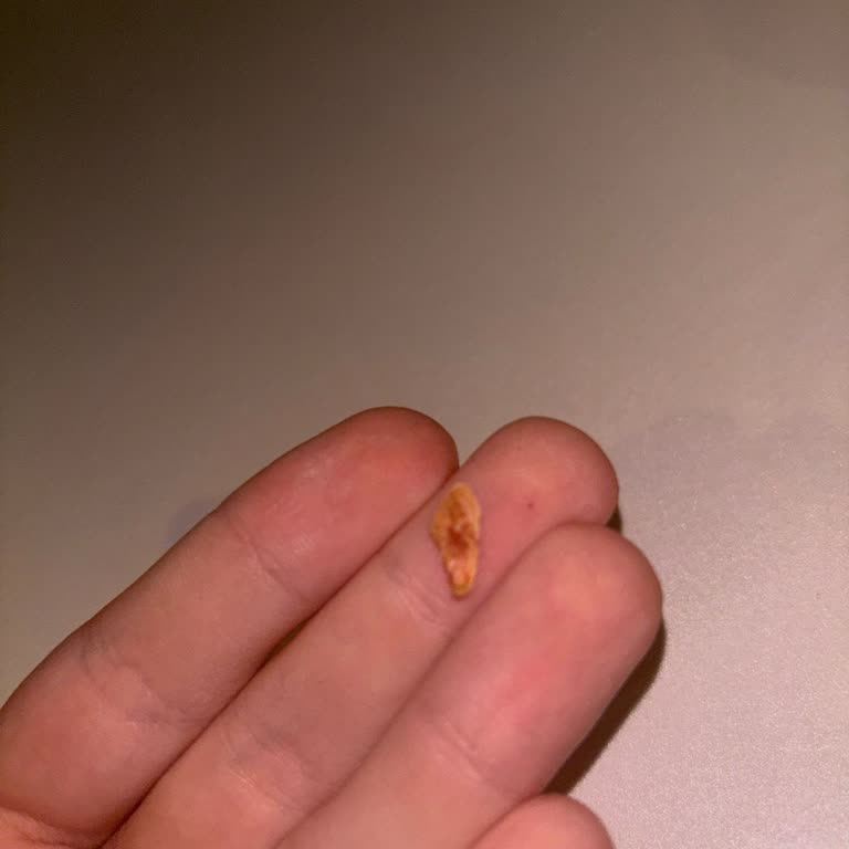 Dürümden Çıkan Kemik Nedeniyle Dişim Kırıldı, Acil Çözüm Bekliyorum