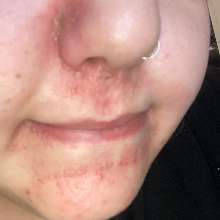 Yüz Temizleme Jeli Sonrası Alerjik Reaksiyon Ve İade Sorunu