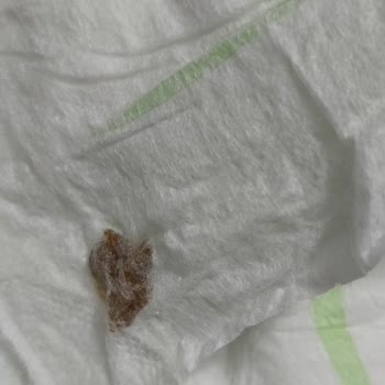 Bebek Bezinde Yabancı Cisim Şoku: Sağlık Riski Ve Güven Kaybı